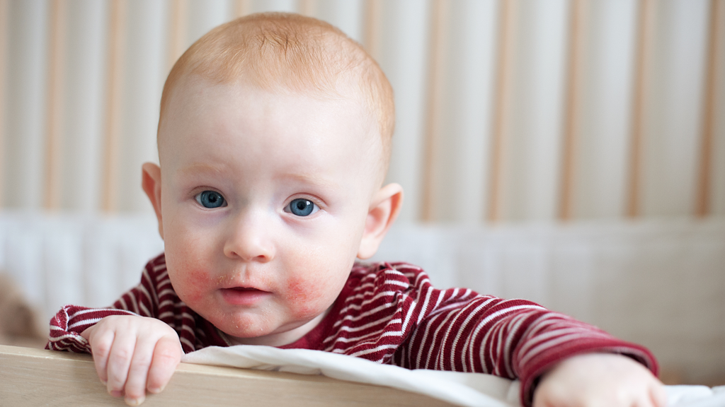 baby with atopic dermatitis