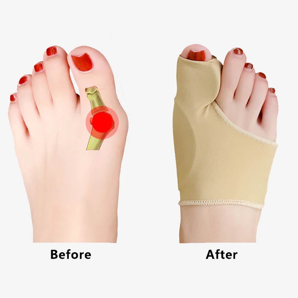 Bunion Corrector Sleeve - Before & After