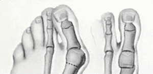 Bunion known as Hallux valgus