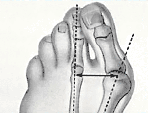 Bunion known as Hallux valgus