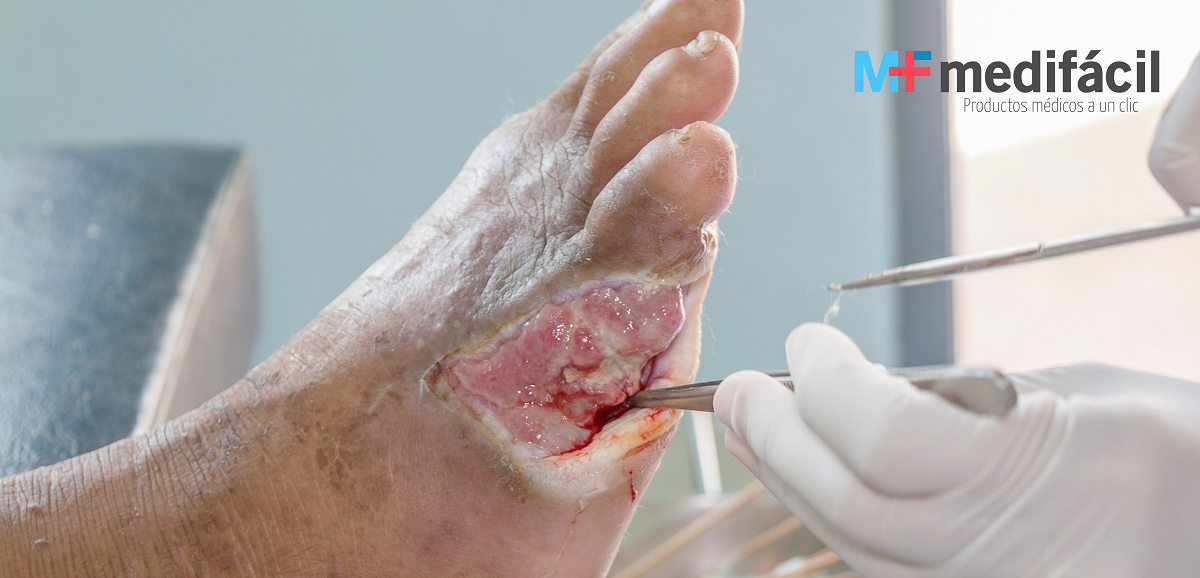 Desbridamiento de herida de pie diabético, principios del manejo de heridas crónicas y agudas: Medifácil