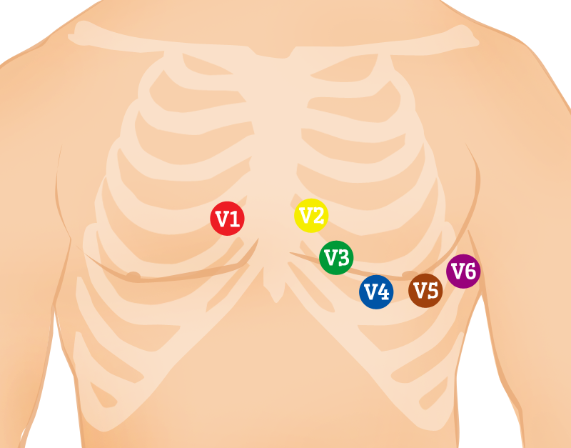 Ecg 10 Lead Placement Chart