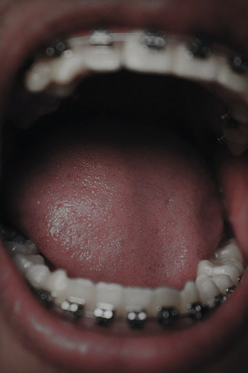 Mouth Sores