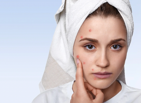 woman with face full of breakouts pimples