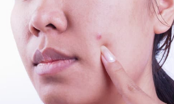 maskne exfoliate acne clear skin blemish