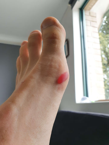 Paddler pains: Tiller bar blisters