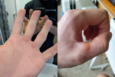 Paddler Pains: Blisters on your hands