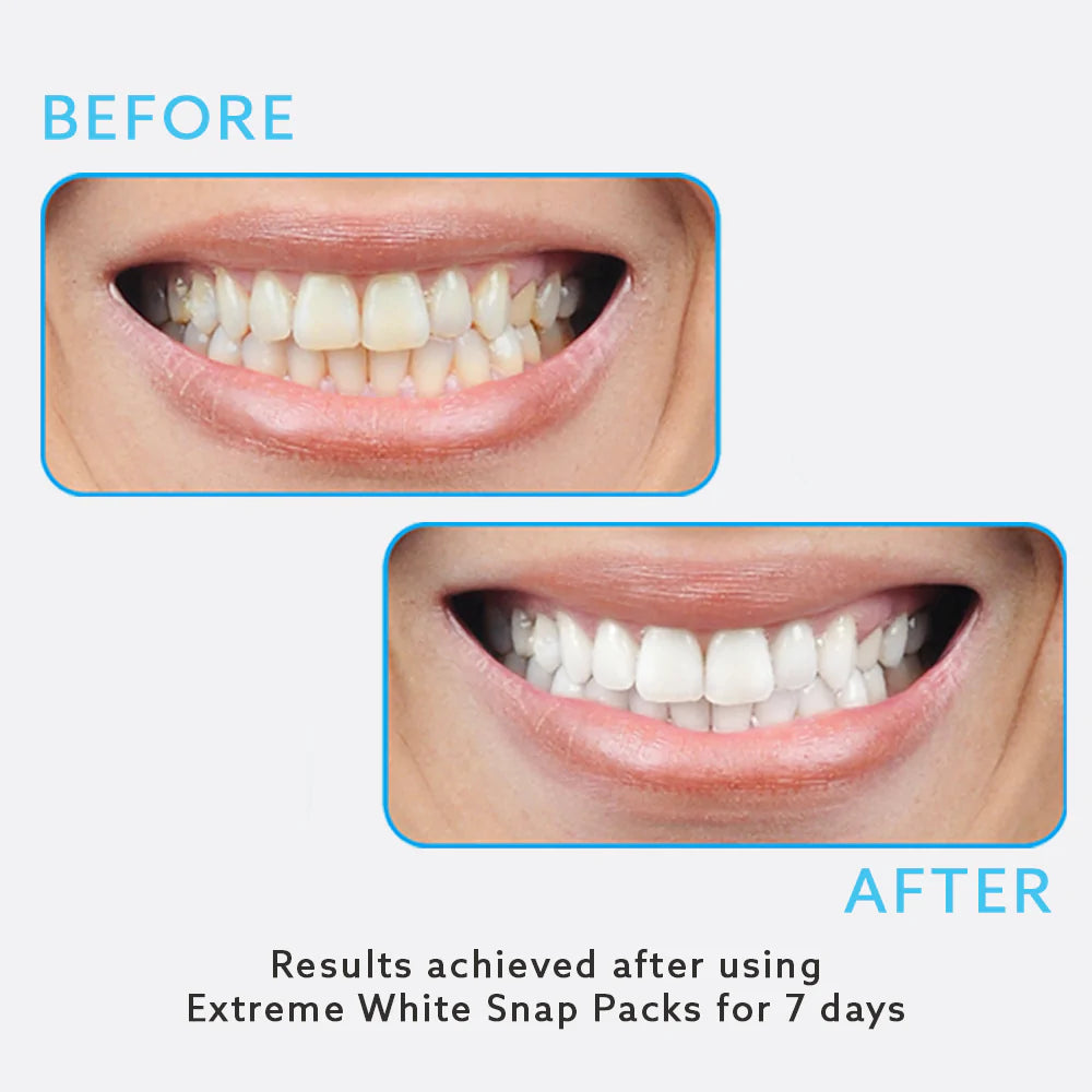 Machtigen Hoorzitting Portaal Boost & Maintain Teeth Whitening Kit – GO SMILE