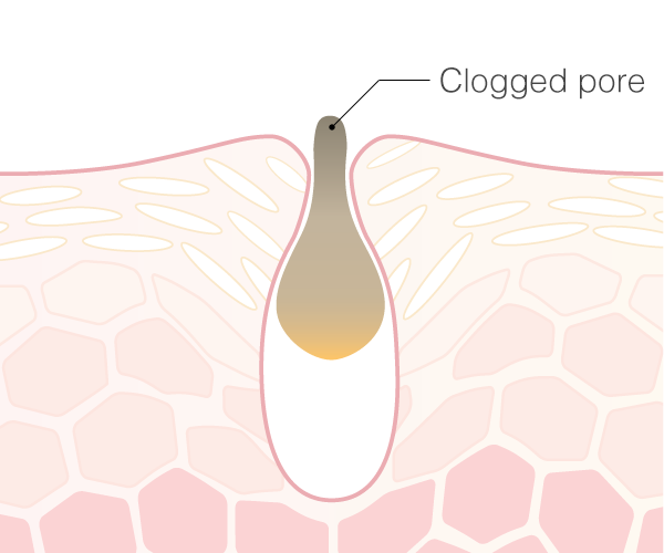 Clogged pore