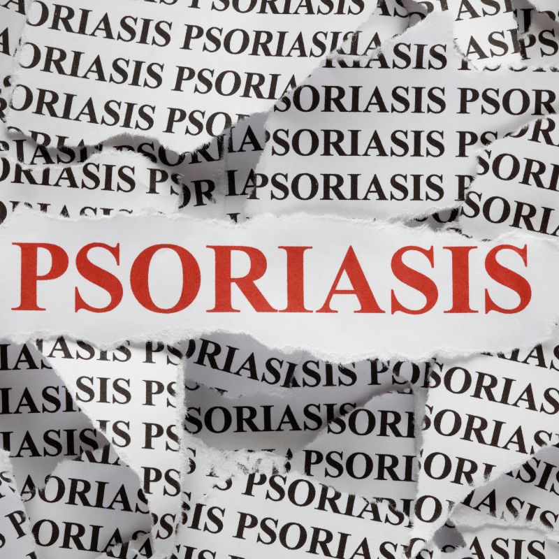 Image of  psoriasis 