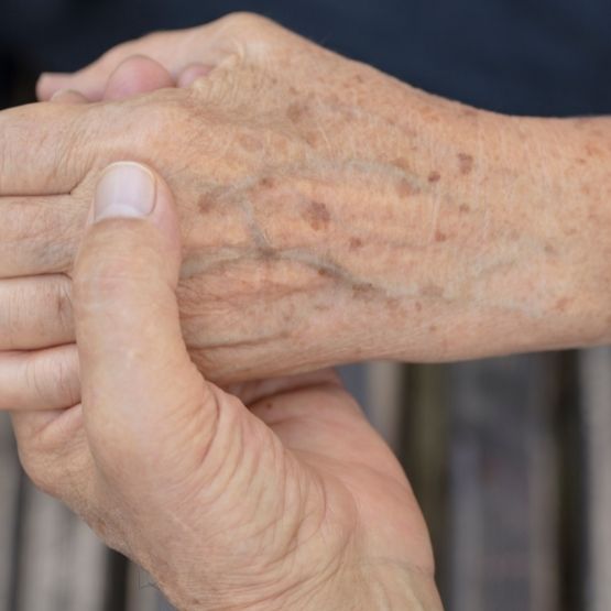 Image of sun spots on the hands before treatment with CameLife Sunspot Cream