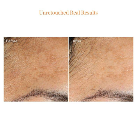 Before and after pigmentation fading results of Murad Vita-C Glycolic Brightening Serum