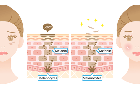 Illustration of melanin and melanocytes affect on skin