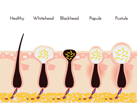 Types of Acne Image with Whitehead, Blackhead, Papule and Pustule