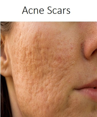 acne scars treament