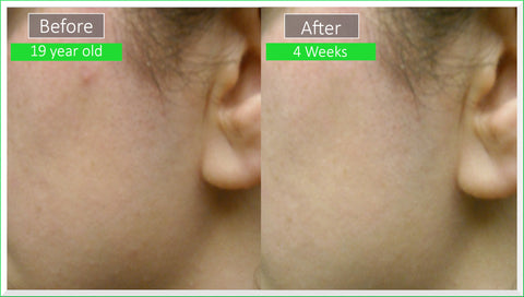 patient before and after images - dr sperons natural skin care