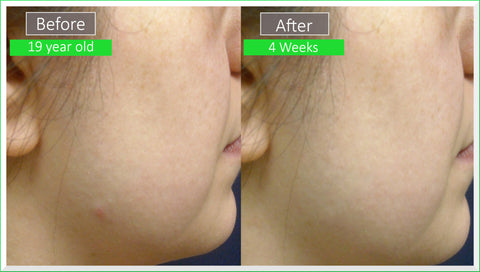 patient before and after images - dr sperons natural skin care