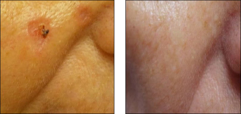 scar treatment before and after pictures