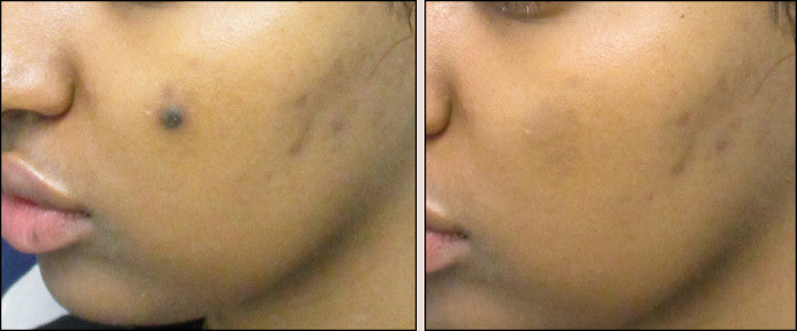 treat scars with best scar treatment