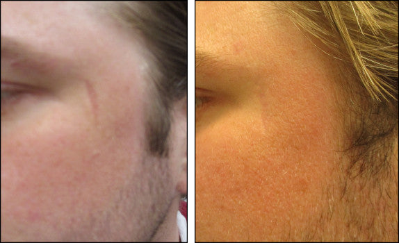 treat scars with best scar treatment