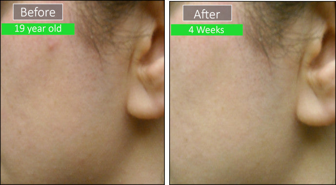 patient before and after images - dr sperons natural skin care