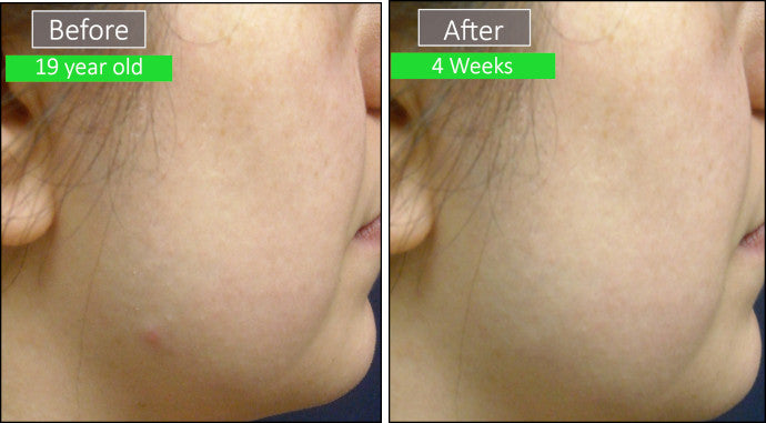 patient before and after images - dr sperons natural skin care