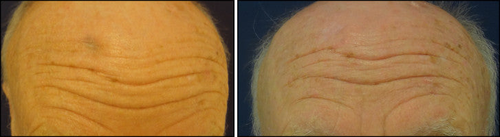 treat scars with best scar treatment