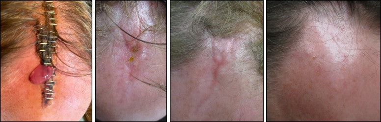 treat scars with best scar treatment