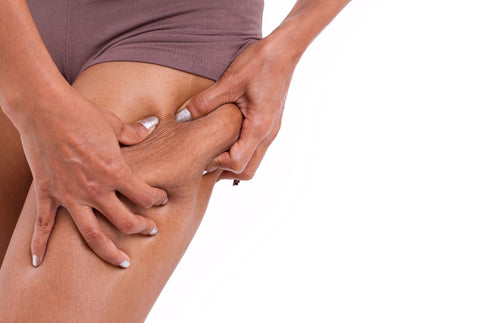 cellulite in women