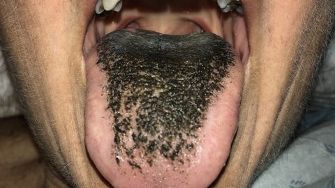 Person that has a hairy black tongue, for AutoBrush