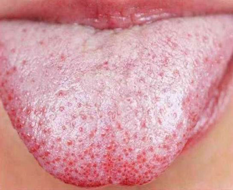 Tongue with yeast infection, for Autobrush
