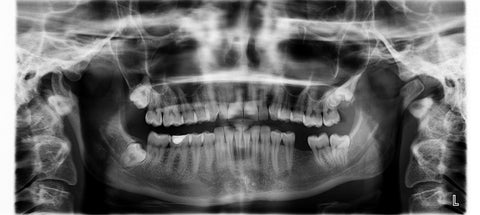 X-ray image of the mouth showing the teeth, for Autobrush