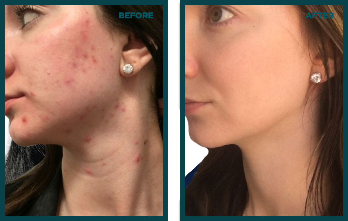 Side-by-side comparison showing a woman's face before and after treatment, highlighting reduced dark spots and smoother skin.