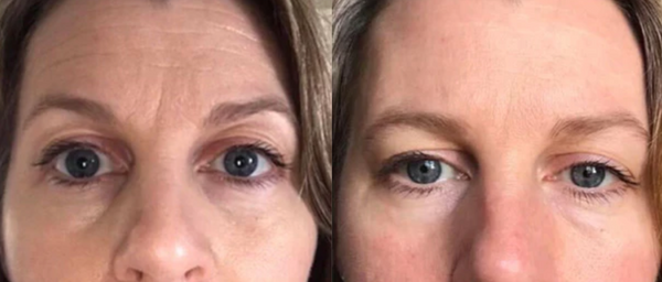 Image montrant une photo de femme avant/après qui montre les bénéfices d'Absolute Collagen sur la peau et les cernes de cette dernière
