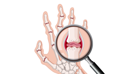 arthritis close up