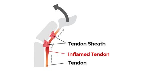 Inflamed tendon causing trigger finger