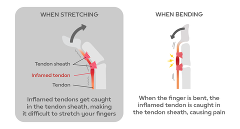 explanation of trigger finger inflammation in the tendon sheath