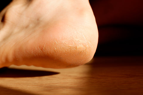 Hakim suleman khan - Cracked heels is a common foot problem, occur in both  men and women, but seems to affect women more often than men. For most  people, having cracked heels