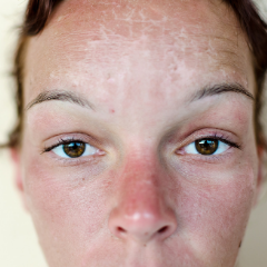 woman with irritated skin