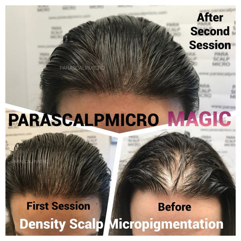 Female Density Scalp Micopigmentation SMP Hair Loss Alopeciaareta Hair Tattoo New York NJ CT PA Staten Island Long