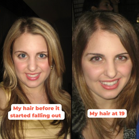 hair loss progress