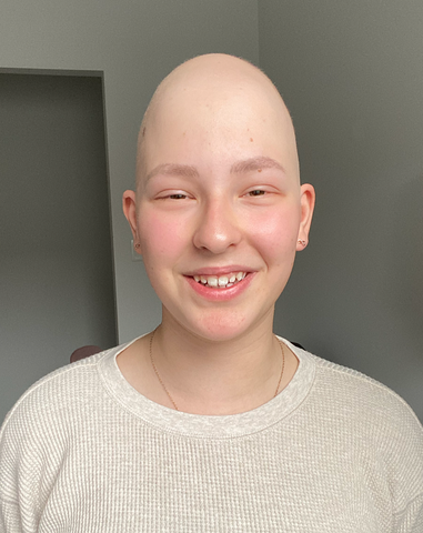 kids with alopecia