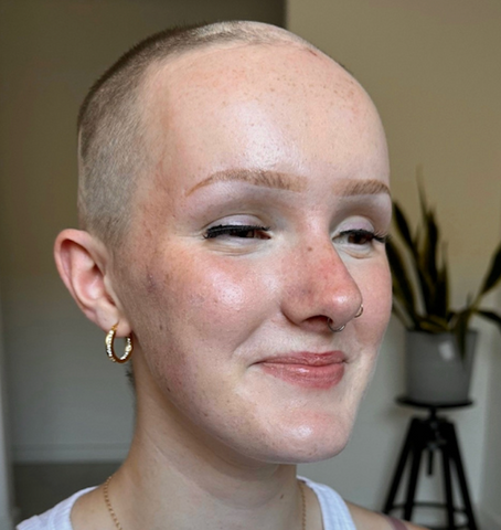 alopecia totalis