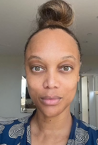 tyra banks hair loss