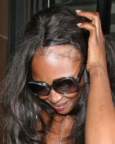 naomi campbell traction alopecia