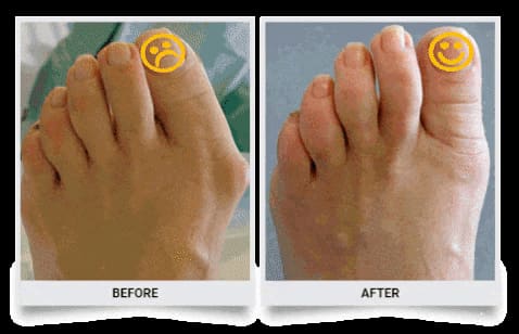 Orthopedic Bunion Corrector 60% OFF