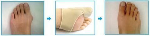 Orthopedic Bunion Corrector 60% OFF