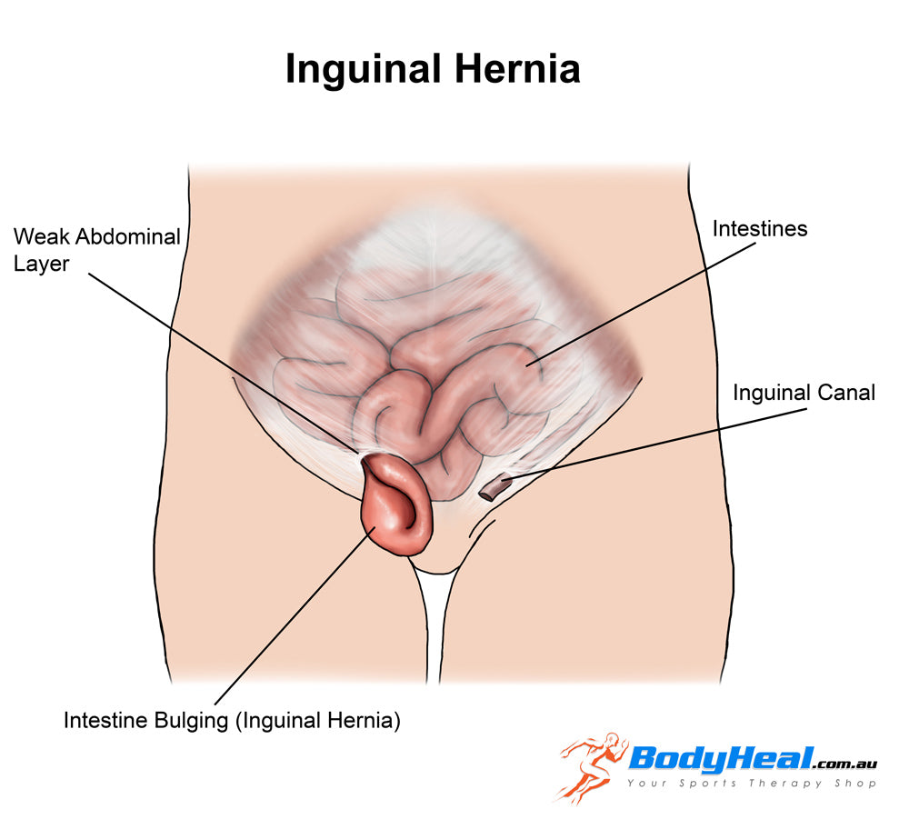 inguinal hernia anatomy
