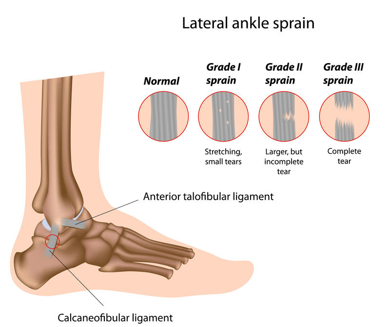 A Guide To Conservative Care For Ankle Sprains