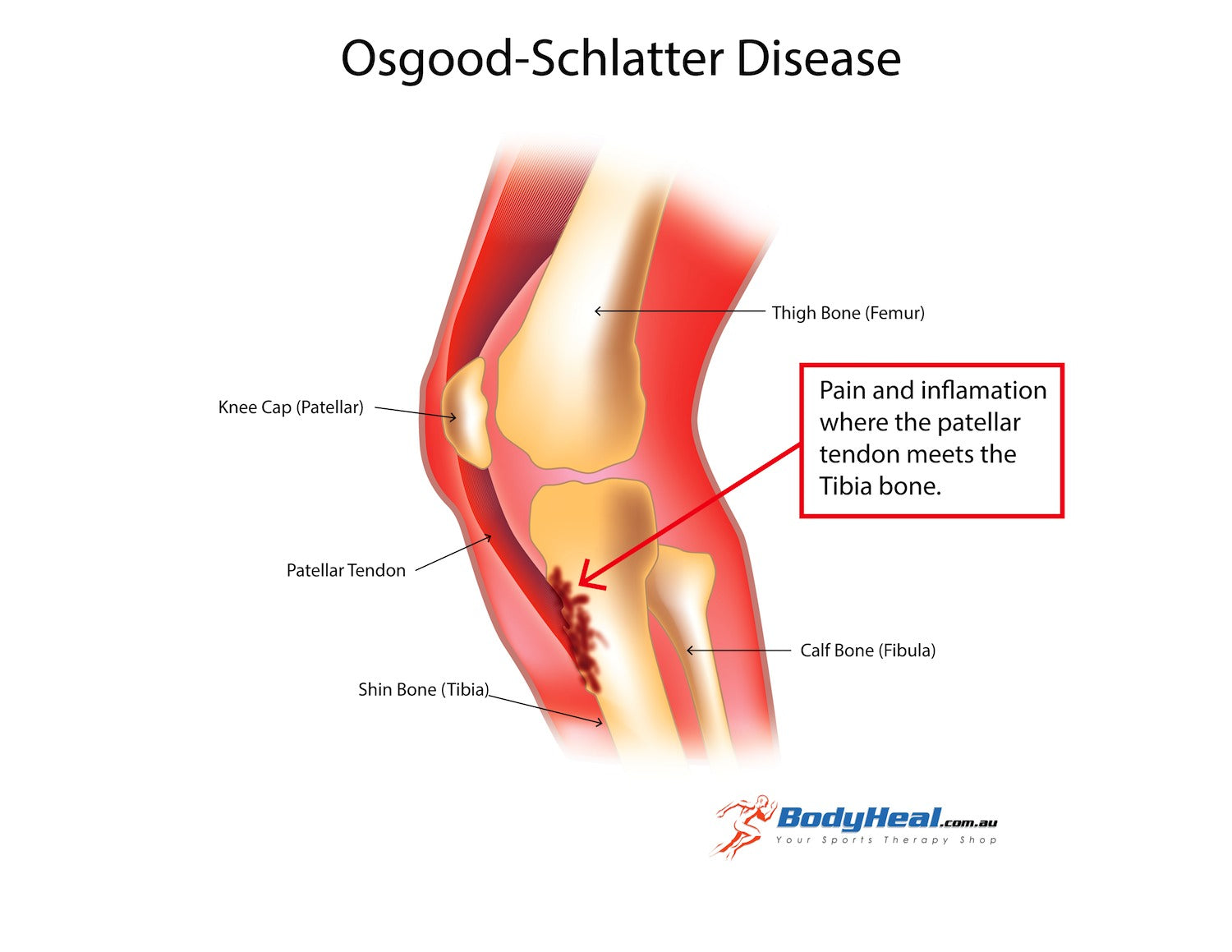 anatomy of knee for osgood-schlatter-disease